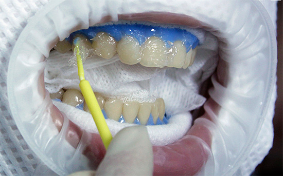 O verdadeiro clareamento dental envolve a destruição química de compostos manchados que compõem a estrutura da camada superficial do esmalte.