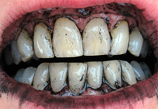 Um método popular antigo de clareamento dos dentes é limpá-los com carvão ...