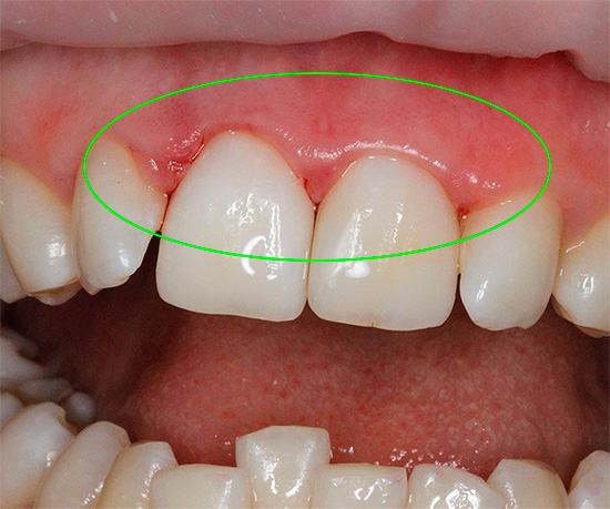 Tentativas de clarear os dentes em casa estão longe de serem seguras e muitas vezes levam a queimaduras graves nas gengivas.