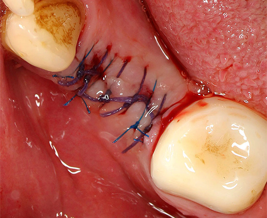 Às vezes, após a extração do dente, suturas são aplicadas à ferida.
