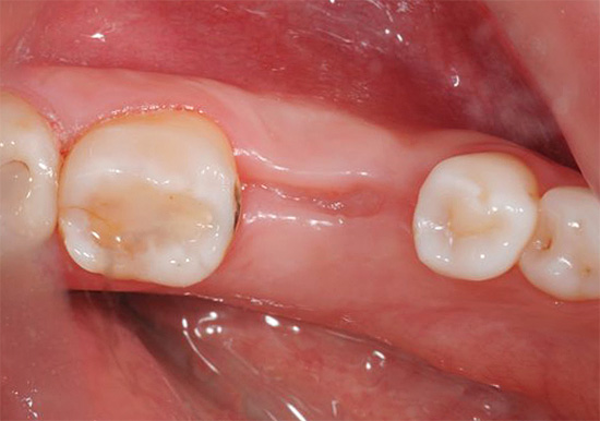 A foto mostra um exemplo de uma gengiva cicatrizada com sucesso (3 meses após a extração do dente).