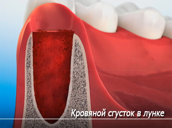 A imagem mostra esquematicamente um coágulo de sangue no alvéolo (orifício do dente).
