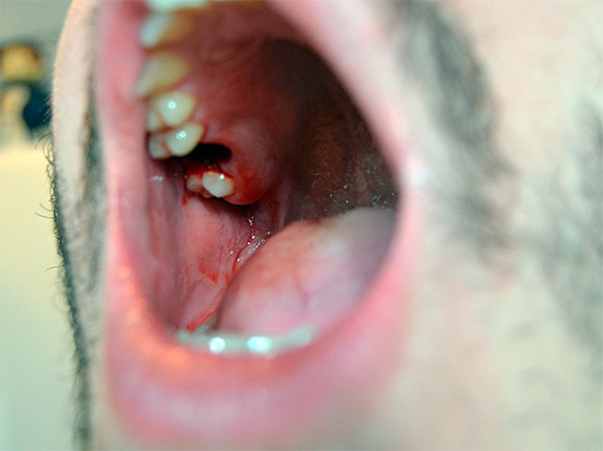 Com a abordagem incorreta de enxaguar a boca após a extração do dente, você pode danificar significativamente o processo de cicatrização natural das gengivas, por isso é importante entender esse problema com mais detalhes.