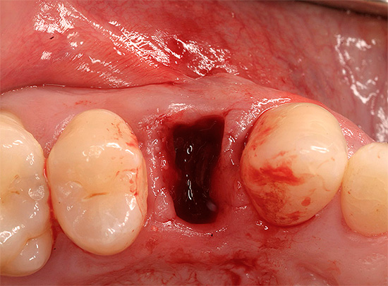 Uma das funções de enxaguar a boca é remover as partículas de alimentos do orifício do dente e reduzir o número de bactérias nele.