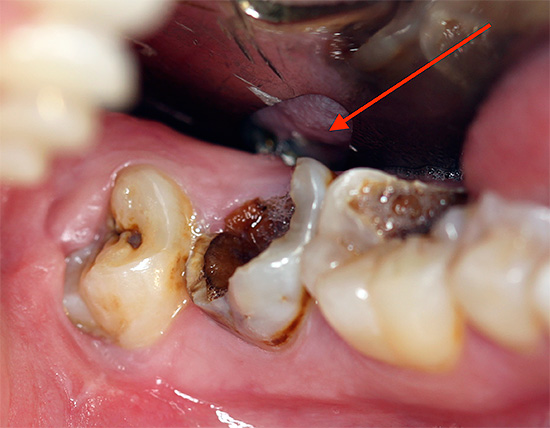 Às vezes, os dentes adjacentes ao dente removido são severamente afetados por cáries, o que cria riscos adicionais de inflamação adicional do soquete dentário.