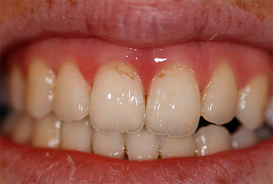 As pastas branqueadoras removem depósitos pigmentados da superfície do esmalte - devido a isso, os dentes ficam visualmente mais claros.