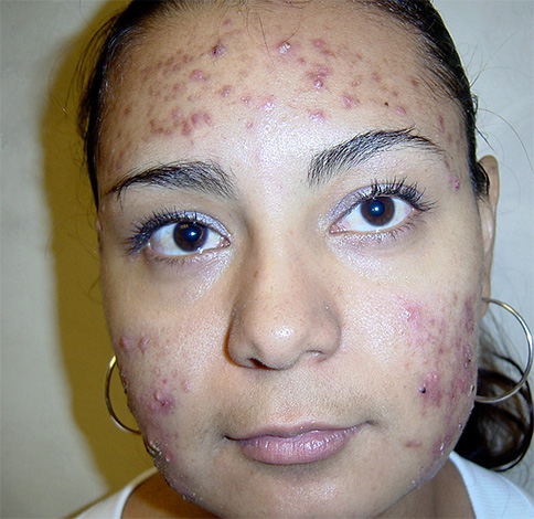 A acne na face geralmente ocorre devido à reprodução excessiva de microrganismos, por exemplo, nas glândulas sebáceas.
