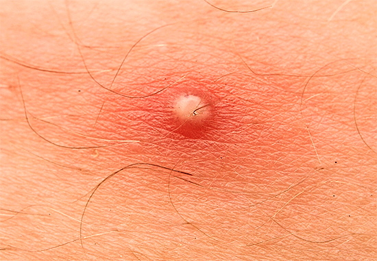Os componentes antibacterianos que compõem os cremes dentais são formas de destruir bactérias que causam inflamação da pele.