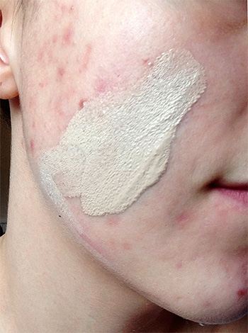 Assim, faz sentido combater a acne apenas com os cremes dentais que contêm anti-sépticos e componentes anti-inflamatórios.
