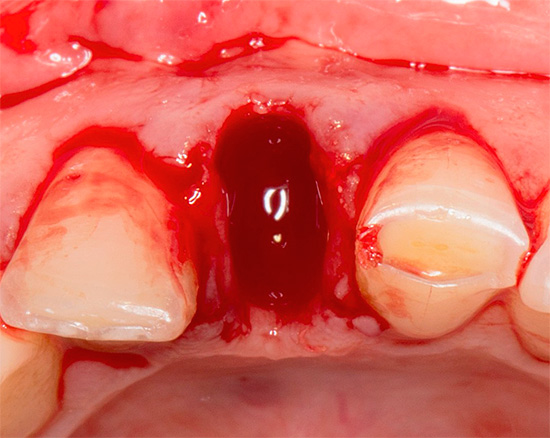 Nos primeiros dias após a extração dentária, lavagens intensivas na boca são inaceitáveis, pois criam o risco de lixiviação de um coágulo sanguíneo do orifício.