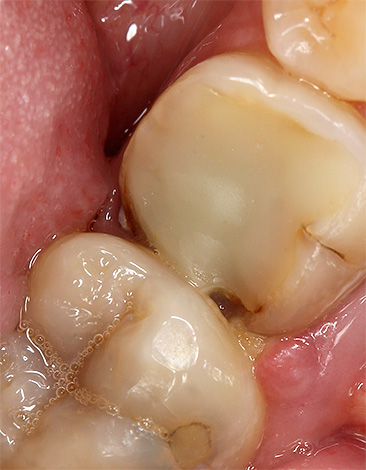 Você pode enxaguar a boca para aliviar a dor de dente, mesmo com sérios problemas com os dentes - cáries profundas, pulpite, periodontite, etc.