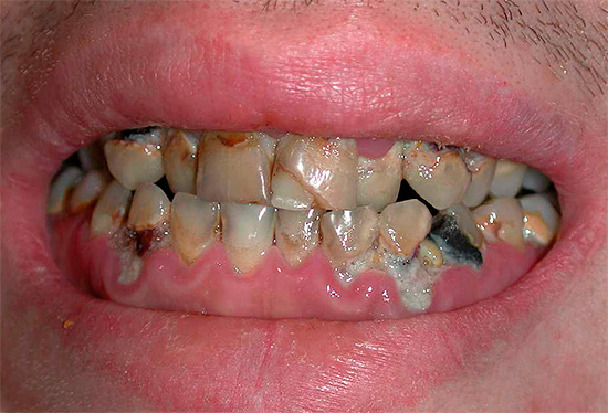 Se os problemas com os dentes forem muito graves, o enxágue pode não ajudar em nada ...