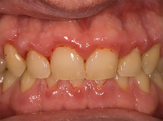 Muitas vezes uma pessoa pensa que seus dentes doem, mas na verdade suas gengivas doem ...