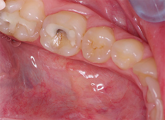 Às vezes, dor intensa ocorre em um dente no qual um recheio antigo ou até novo é instalado.