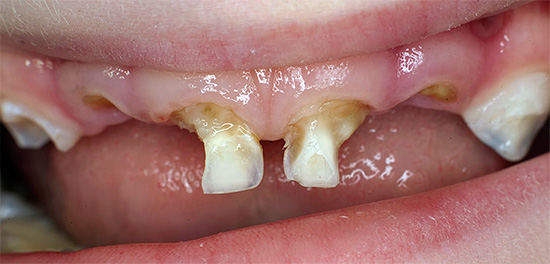 A fotografia mostra os dentes de leite do bebê destruídos por cárie.