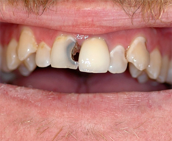 É importante entender que, se você não tratar os dentes, mas apenas se livrar da dor, com o tempo a situação só piorará.