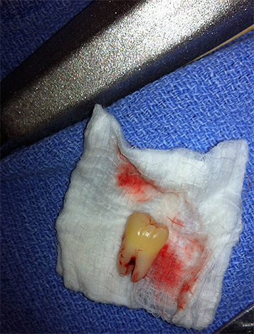 Após a extração do dente, os cirurgiões geralmente prescrevem analgésicos.