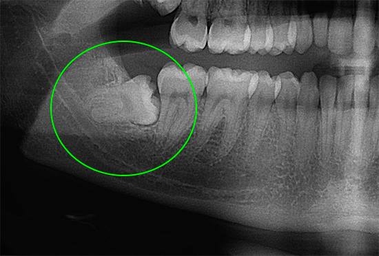 A dor também pode ocorrer, por exemplo, devido a um dente do siso que cresce incorretamente ...