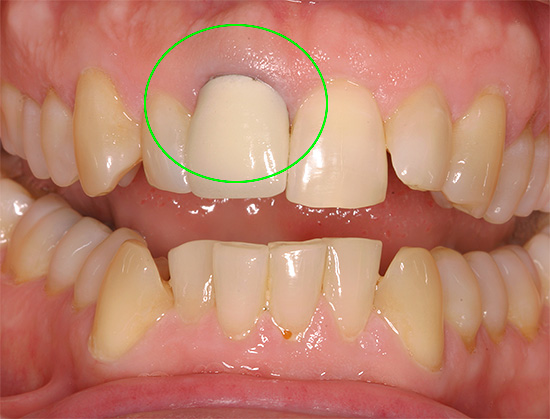 Às vezes, uma coroa colocada em um dente se torna a causa da dor.