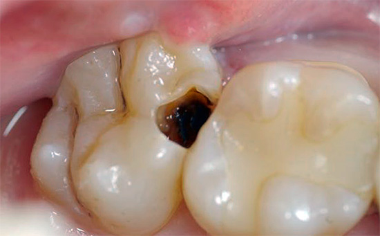 Às vezes, você pode se livrar da dor de dente em casa usando um cotonete umedecido, por exemplo, com uma solução de lidocaína e incorporado em uma cavidade cariosa.