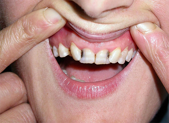 O hábito de suprimir constantemente a dor de dente com pílulas geralmente não leva a nada de bom ...