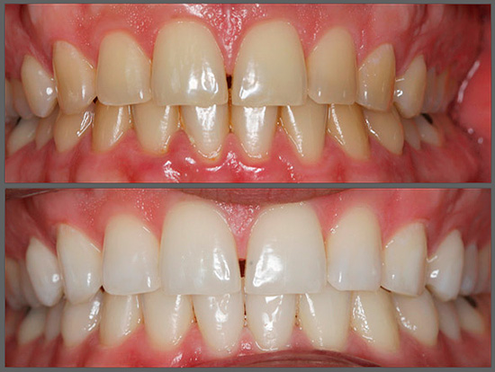 É assim que os dentes ficam antes e depois do clareamento.