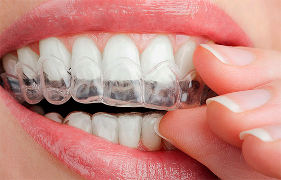 O clareamento em casa pode ser realizado usando protetores bucais individuais feitos em uma clínica odontológica, especialmente para você.