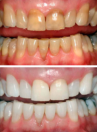 Uma fotografia dos dentes antes e depois do clareamento da foto usando o método Zoom.