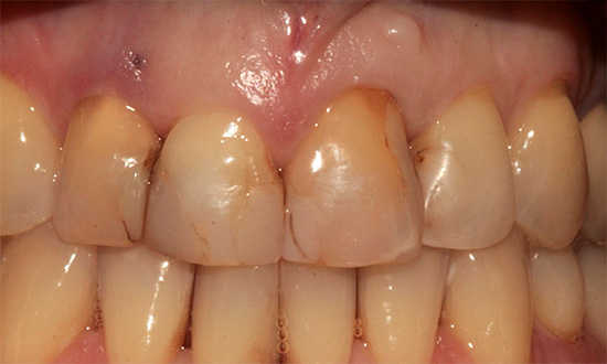 Se houver obturações nos dentes da frente, após o procedimento de clareamento, elas poderão parecer mais escuras do que o esmalte circundante.