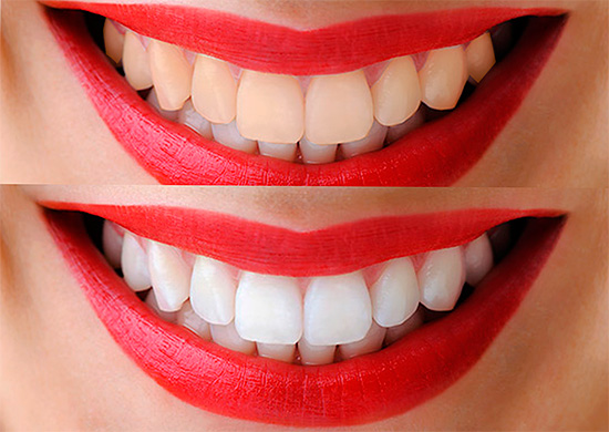 Com a fotodegradação dos dentes, é realmente possível clarear o esmalte por 12 e ainda mais tons em um curto espaço de tempo.