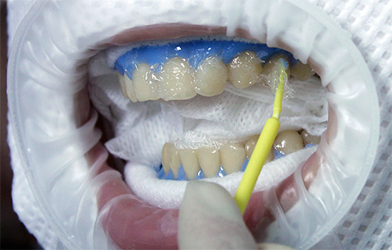 A foto mostra a aplicação de um gel clareador na superfície dos dentes da frente.
