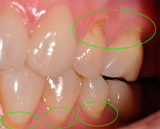 O uso prolongado de pastas altamente abrasivas pode agravar facilmente o problema de defeitos em forma de cunha (mostrado na foto).