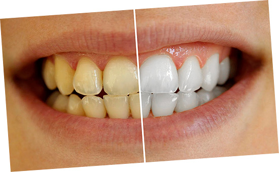 É realmente possível em casa clarear eficazmente os dentes sem danificar o esmalte? Vamos tentar descobrir juntos ...