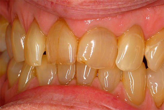 A causa do amarelecimento do esmalte dos dentes pode ser, por exemplo, o fumo, bem como o uso regular de café e chá fortes.