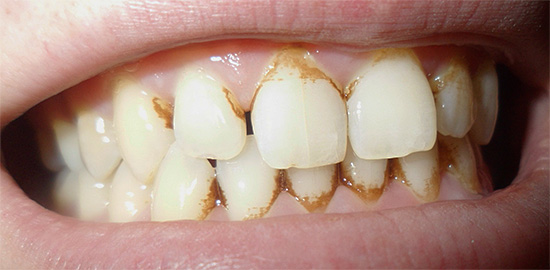 Se vedi abbondanti depositi dentali sulla superficie dello smalto, è meglio sottoporsi a una procedura di igiene orale professionale.