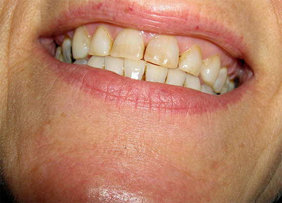 Se lo smalto dei denti ha naturalmente una leggera tonalità, allora è sufficiente rimuovere la placca dipinta da essa in modo che il sorriso diventi di nuovo bianco come la neve.