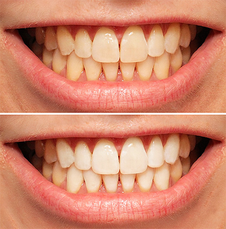 La foto mostra un esempio di come possono apparire i denti prima e dopo la procedura di sbiancamento.