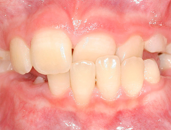 Esistono molti tipi diversi di anomalie del morso del dente - ne parleremo più avanti ...
