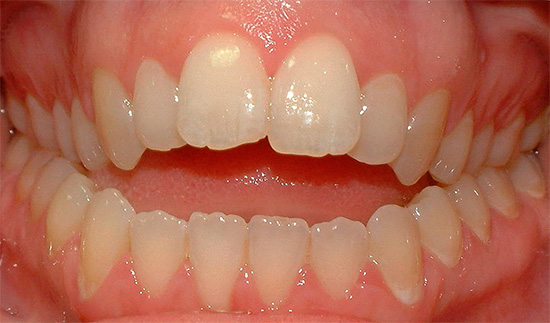 Quando i denti nella sezione anteriore non si chiudono, parlano di un morso aperto.
