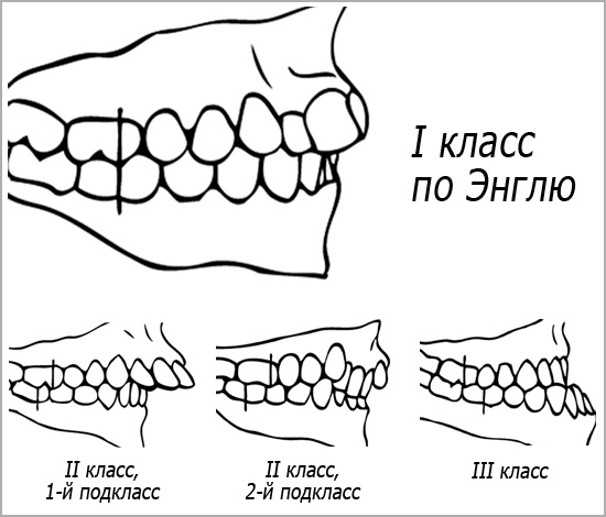 Classificazione angolare della malocclusione