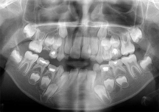 Ortopantomogramma in un bambino (foto panoramica della dentatura).