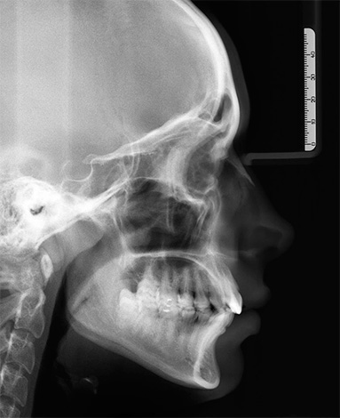 Il tele-roentgenogram della testa aiuta l'ortodontista a trarre una conclusione sulle cause dello sviluppo di una malocclusione.