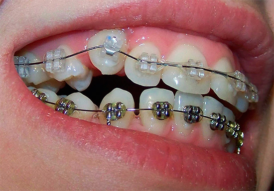 Va tenuto presente che la correzione del morso con l'aiuto di apparecchi ortodontici richiede molto tempo, fino a diversi anni.