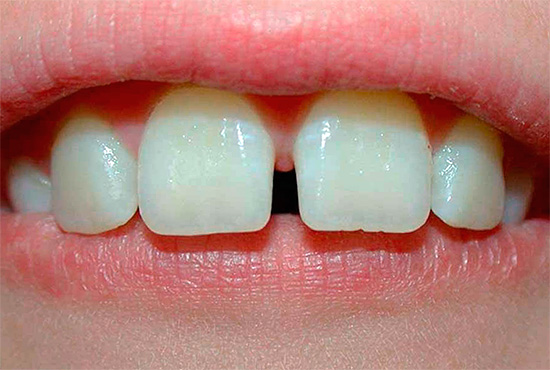 La foto mostra un esempio di diastema mediano.