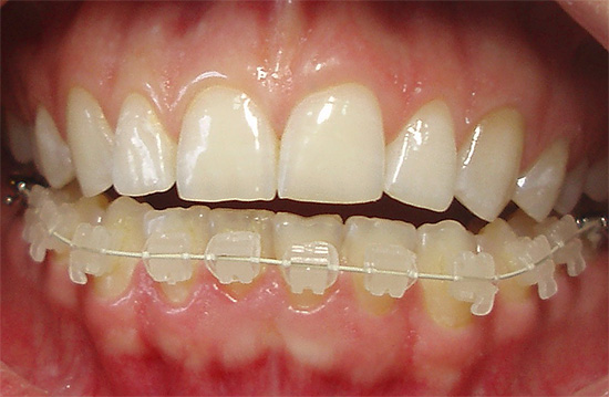 Esempio di parentesi graffe ceramiche