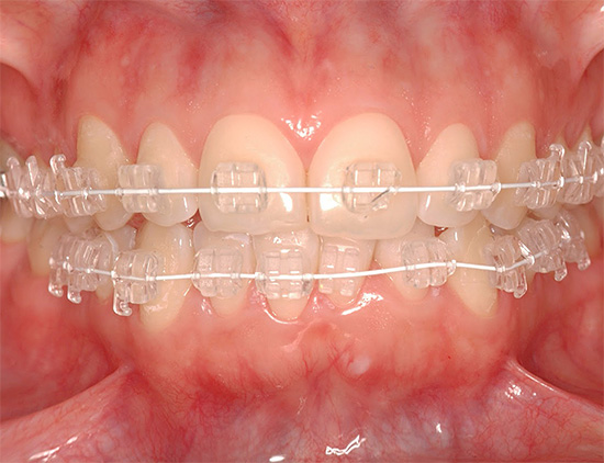 Le parentesi graffe di zaffiro sono tra le più invisibili sui denti.