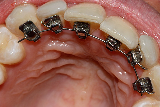Le parentesi graffe linguali sono attaccate al lato interno (linguale) dei denti, quindi sono invisibili agli altri.