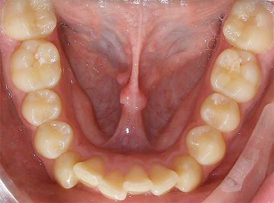 Una delle anomalie più comuni del morso è l'affollamento dei denti.