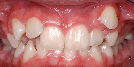 A volte un dente può scoppiare in un luogo atipico per questo, che alla fine porta alla formazione di una malocclusione.