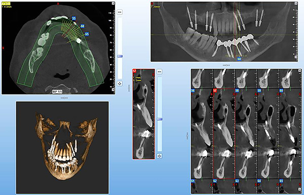 A modelagem computacional com implantação basal permite alcançar o posicionamento mais preciso dos implantes, mesmo nos casos mais difíceis, minimizando a probabilidade de um erro médico.